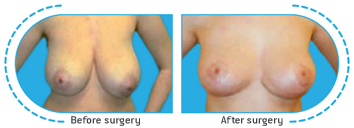 αυξητική μαστών,ανόρθωση,μείωση μαστών,μαστεκτομή,σιλικόνη,μαστοπλαστική