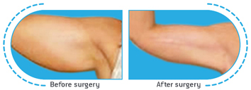 ανόρθωση βραχιόνων,χαλαρά μπράτσα,συσφίξη βραχιόνων