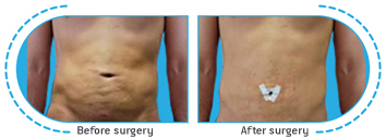 λιποπλαστική,λιποαναρρόφηση,τοπικό πάχος,vibro lipo,λείo σφριγηλό δέρμα,λιποαναρρόφηση κοιλίας,διαδερμική μικροθεραπεία