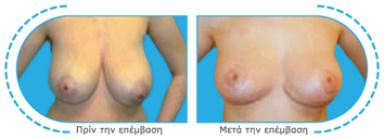 αυξητική μαστών,ανόρθωση,μείωση μαστών,μαστεκτομή,σιλικόνη,μαστοπλαστική