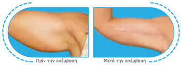 ανόρθωση βραχιόνων,χαλαρά μπράτσα,συσφίξη βραχιόνων