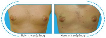 γυναικομαστία,ψευδογυναικομαστία,αληθή γυναικομαστία