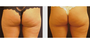 ACOUSTIC WAVE THERAPY